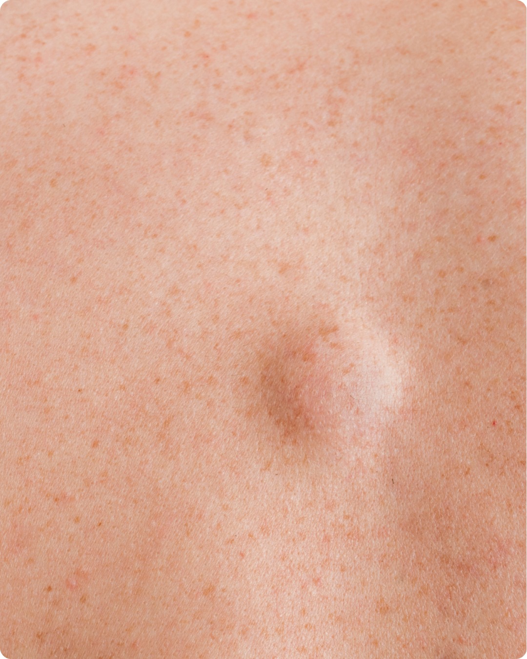 Excisão de Lesões (Benignas e Malignas)